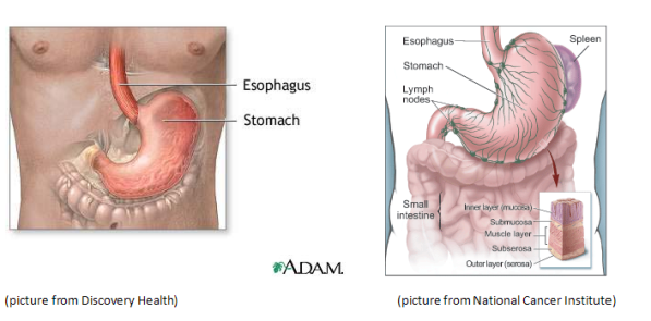 aggressive cancer in abdomen